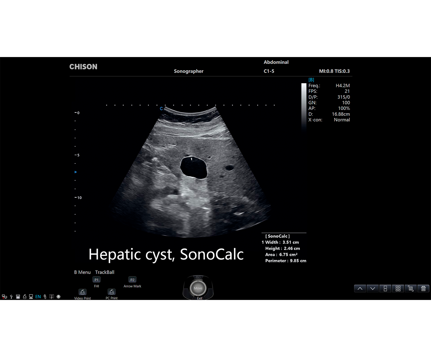 SonoPort SonoCalc quiste hepático